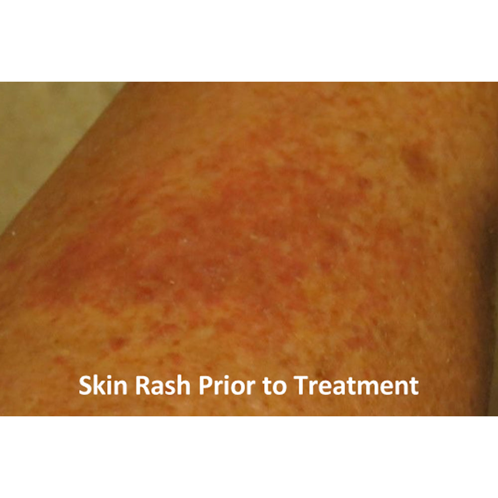 Eczema and Psoriasis Relief Cream