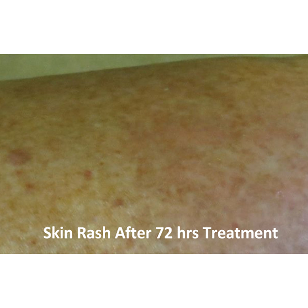 Eczema and Psoriasis Relief Cream