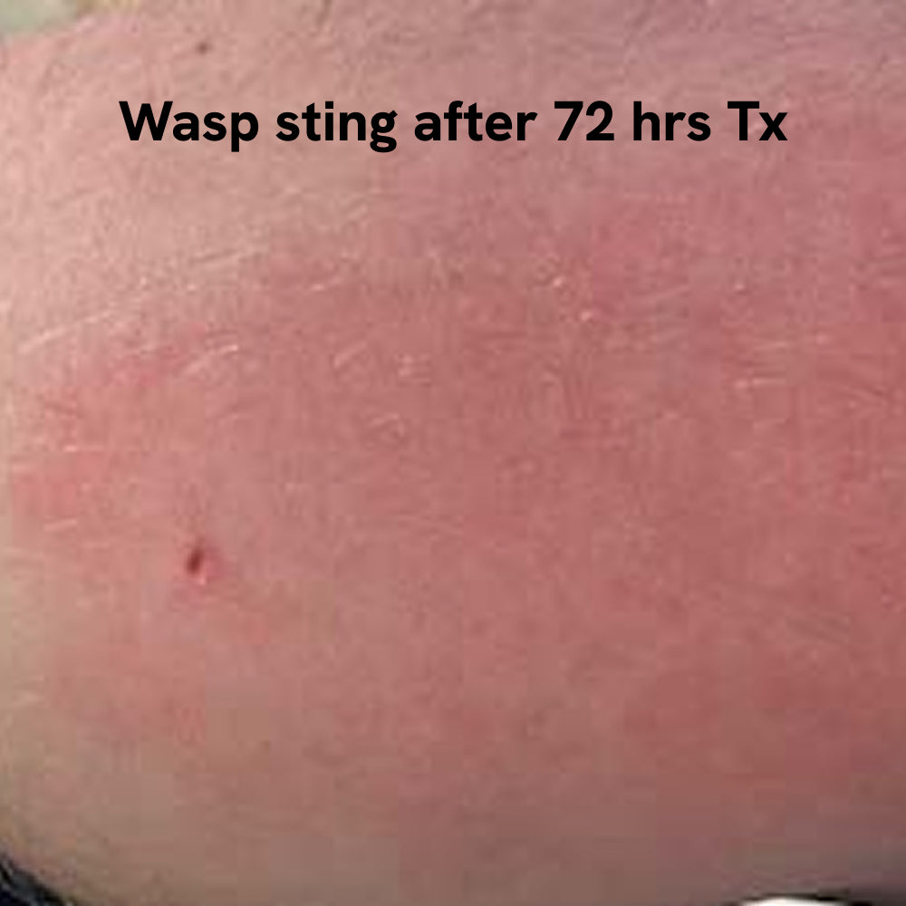Insect Bite Stick | Relief Balm