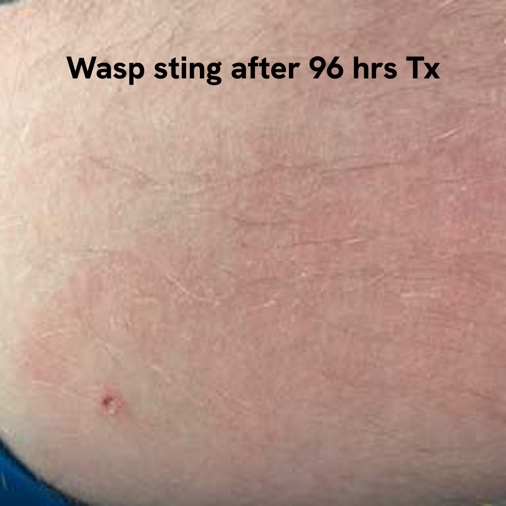 Insect Bite Stick | Relief Balm