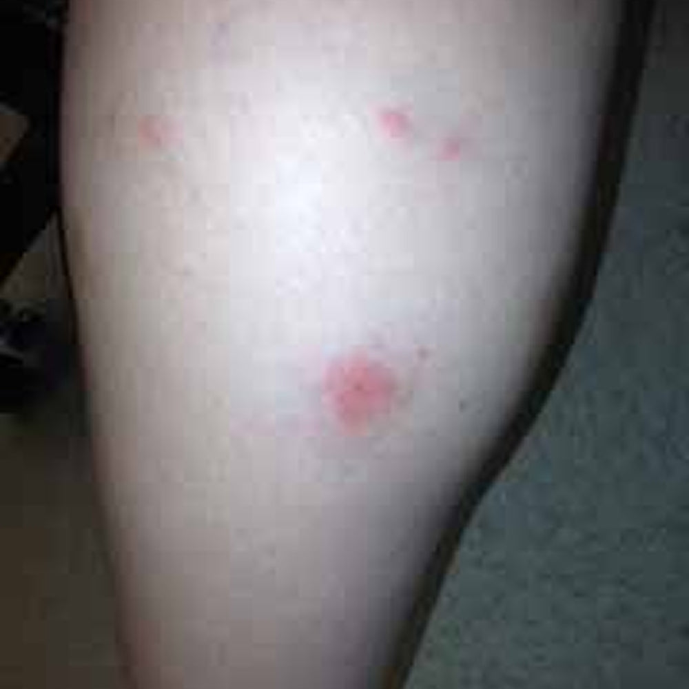 Insect Bite Stick | Relief Balm