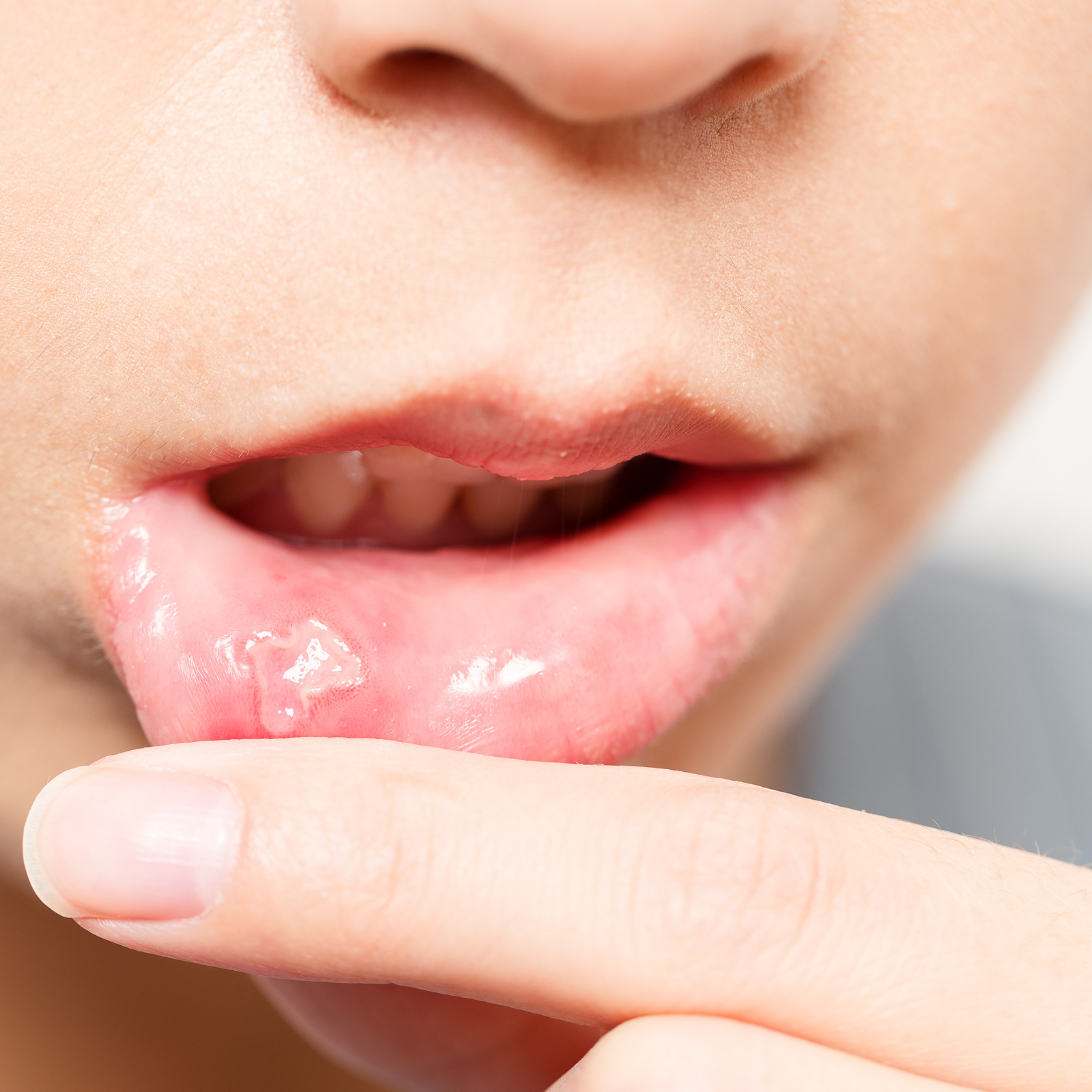 Canker Sore Pain and Mouth Irritation: Finding Symptomatic Relief