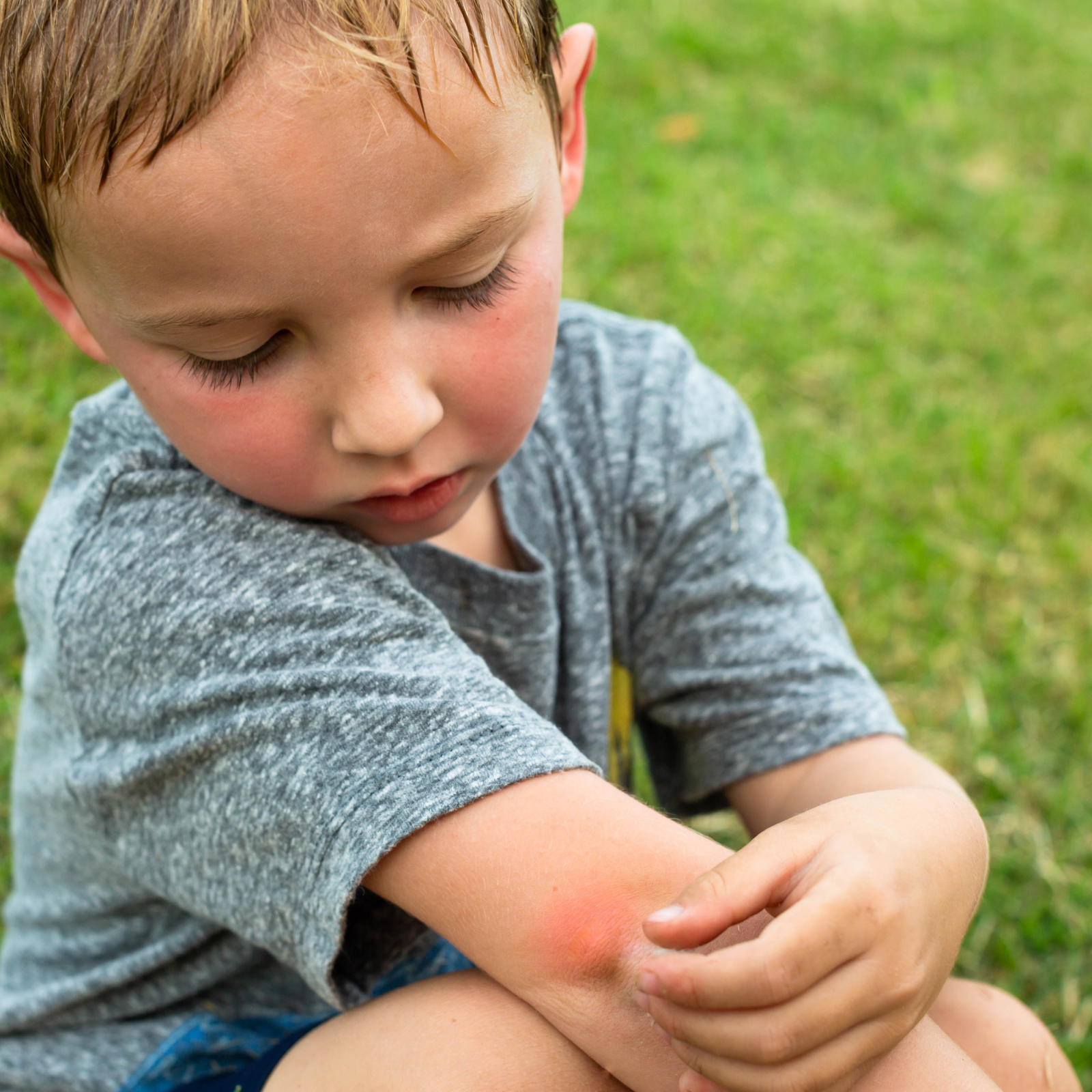 Insect Bite Relief for Mosquitoes, Chiggers, Ants and More
