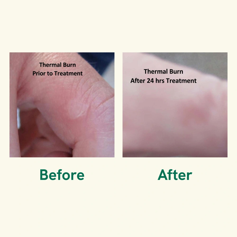 Burn (Liquid) Gel / Burn Relief Gel