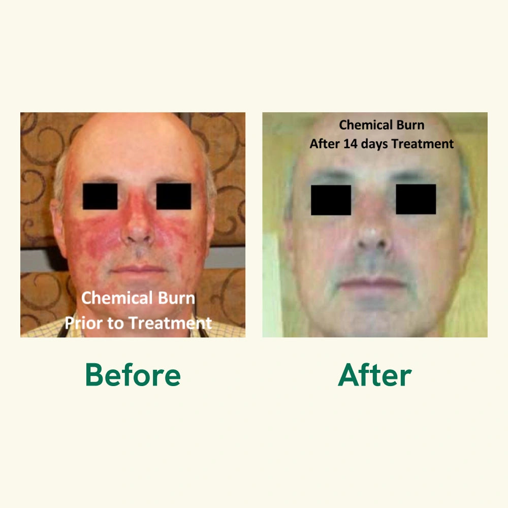 Burn (Liquid) Gel / Burn Relief Gel