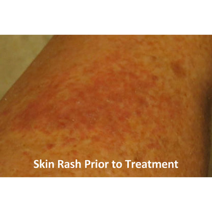 Eczema and Psoriasis  Relief Cream