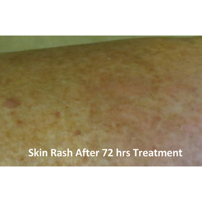 Eczema and Psoriasis  Relief Cream