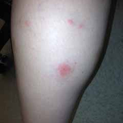 Insect Bite Stick | Relief Balm